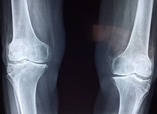 Kiedy powinno się nosić but ortopedyczny?